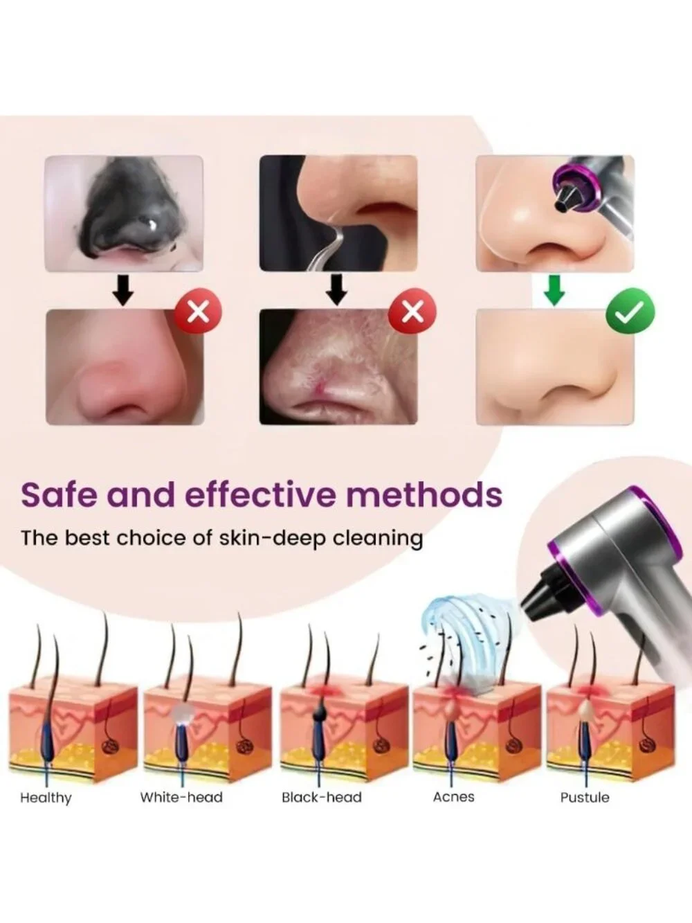 Heated Blackhead Remover Pore Vacuum 5 Heads 3 Suction Levels Facial NIB